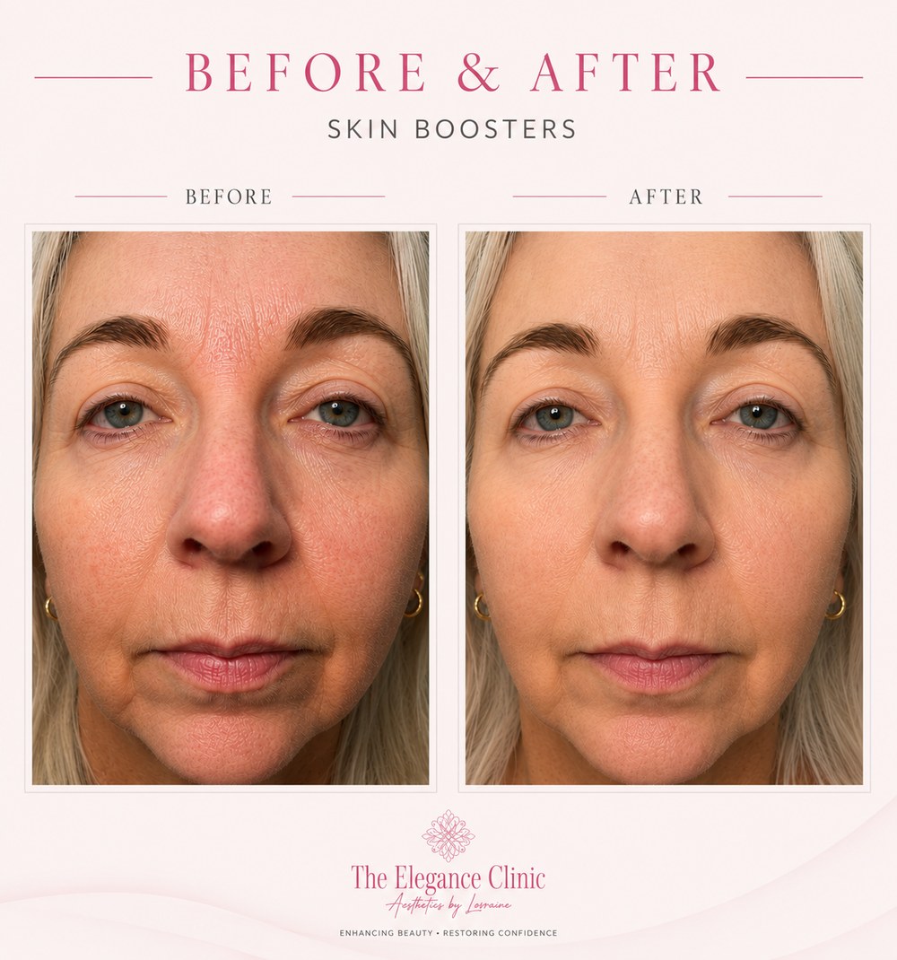 Skin Boosters before and after at The Elegance Clinic, Welwyn Garden City